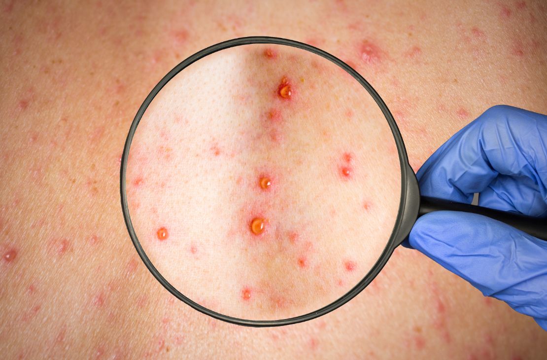 Brasil tem mais de 200 casos confirmados de varíola dos macacos