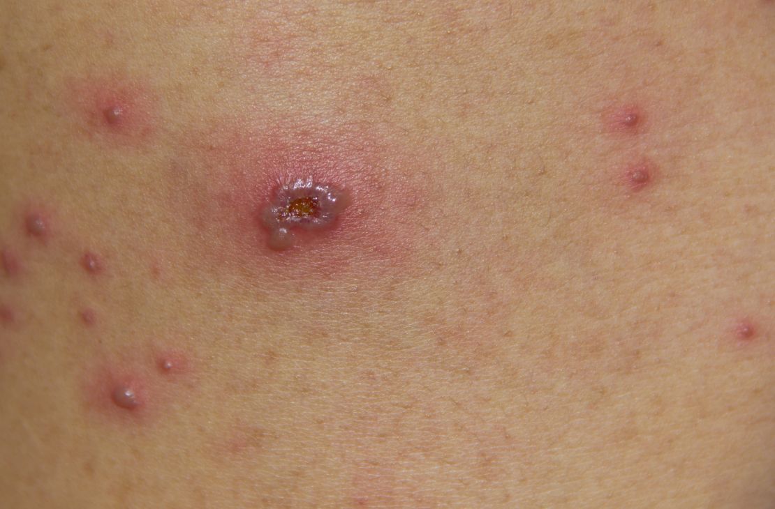 Mato Grosso do Sul confirma primeiro caso de varíola dos macacos