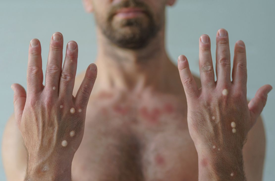 Anvisa recebe pedido de registro para teste de varíola dos macacos