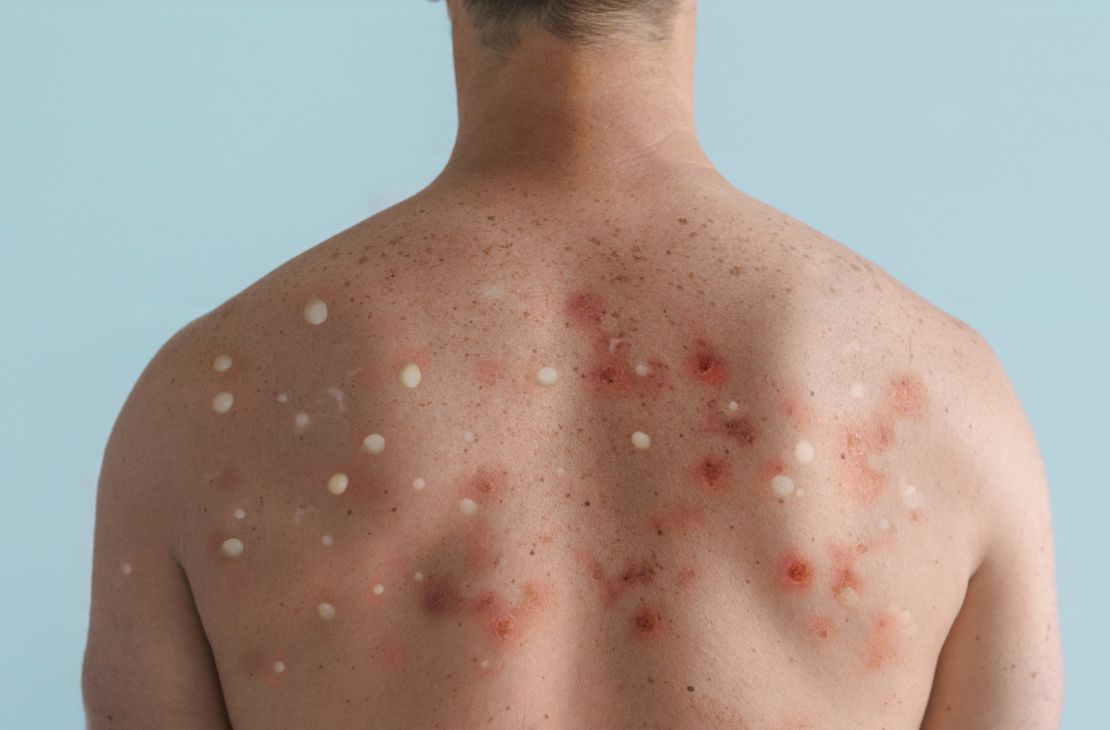 Varíola dos macacos: calendário de vacinação deve sair nesta semana