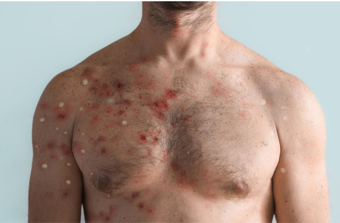 SES confirma mais dois e sobem para 12 os casos de varíola dos macacos em MS