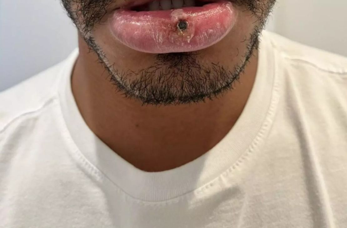 Mais três casos de varíola dos macacos são confirmados em MS e total chega a 19