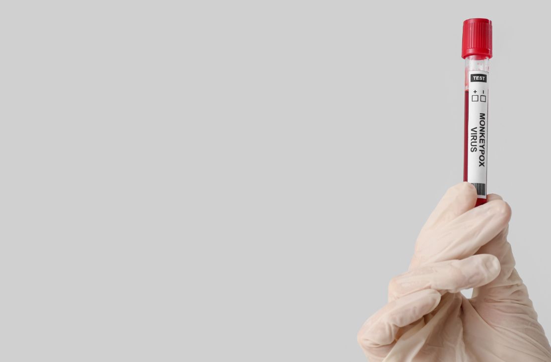 MS tem 87 casos confirmados de varíola dos macacos, aponta secretaria de Saúde