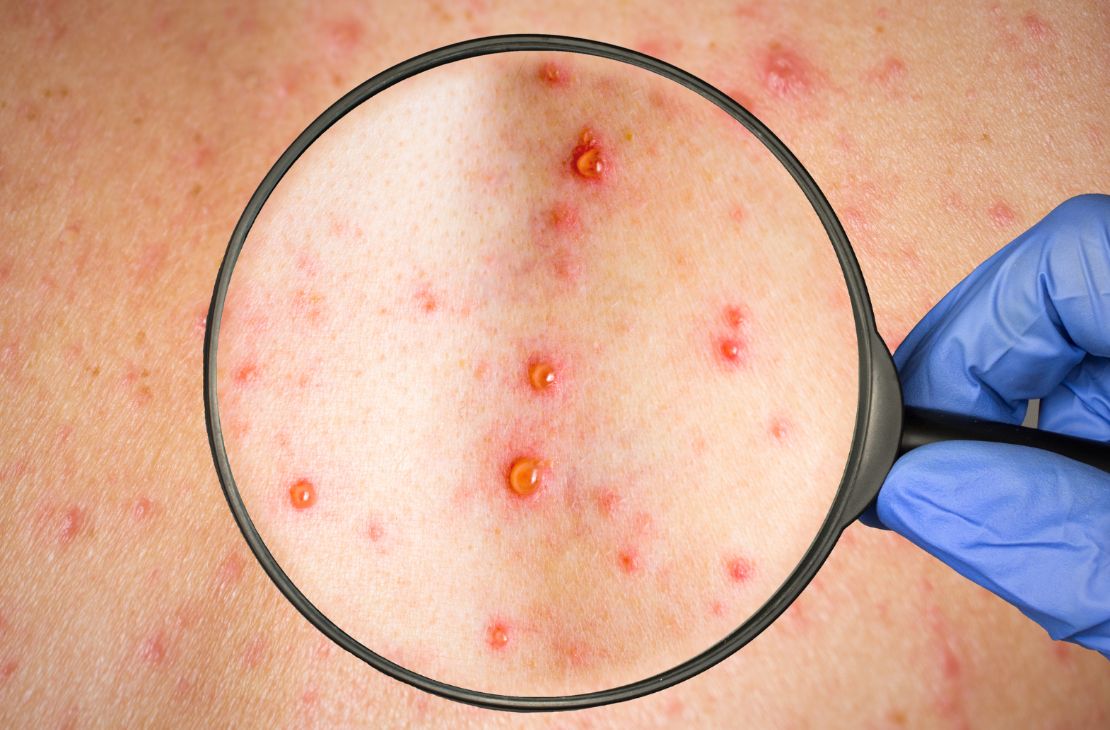 Brasil registra 8ª morte por Monkeypox e se torna país com mais óbitos