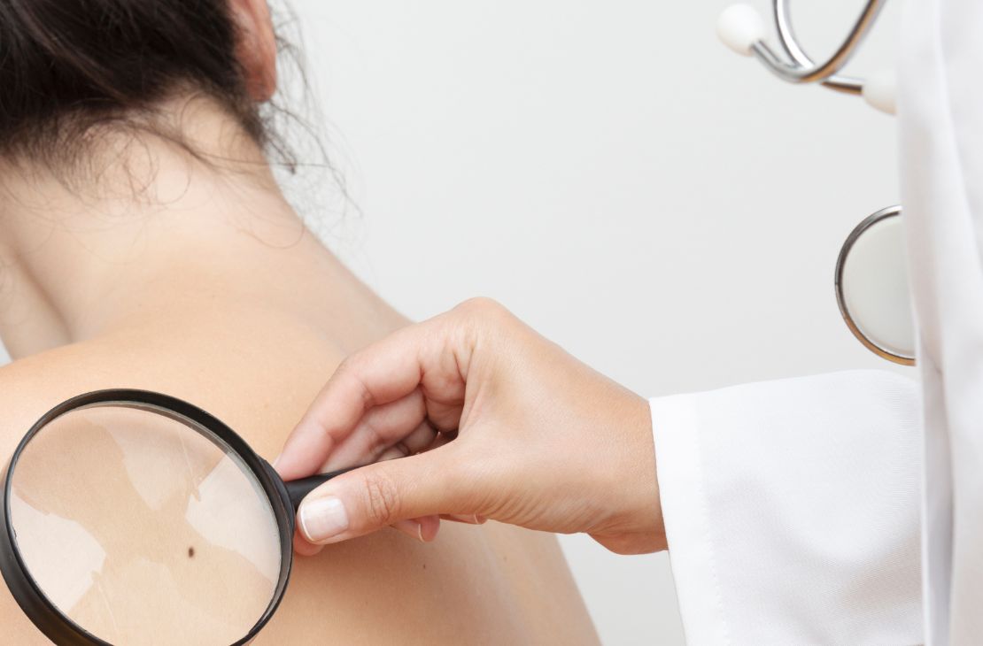 Tecnologia para tratar câncer de pele é aprovado para uso no SUS