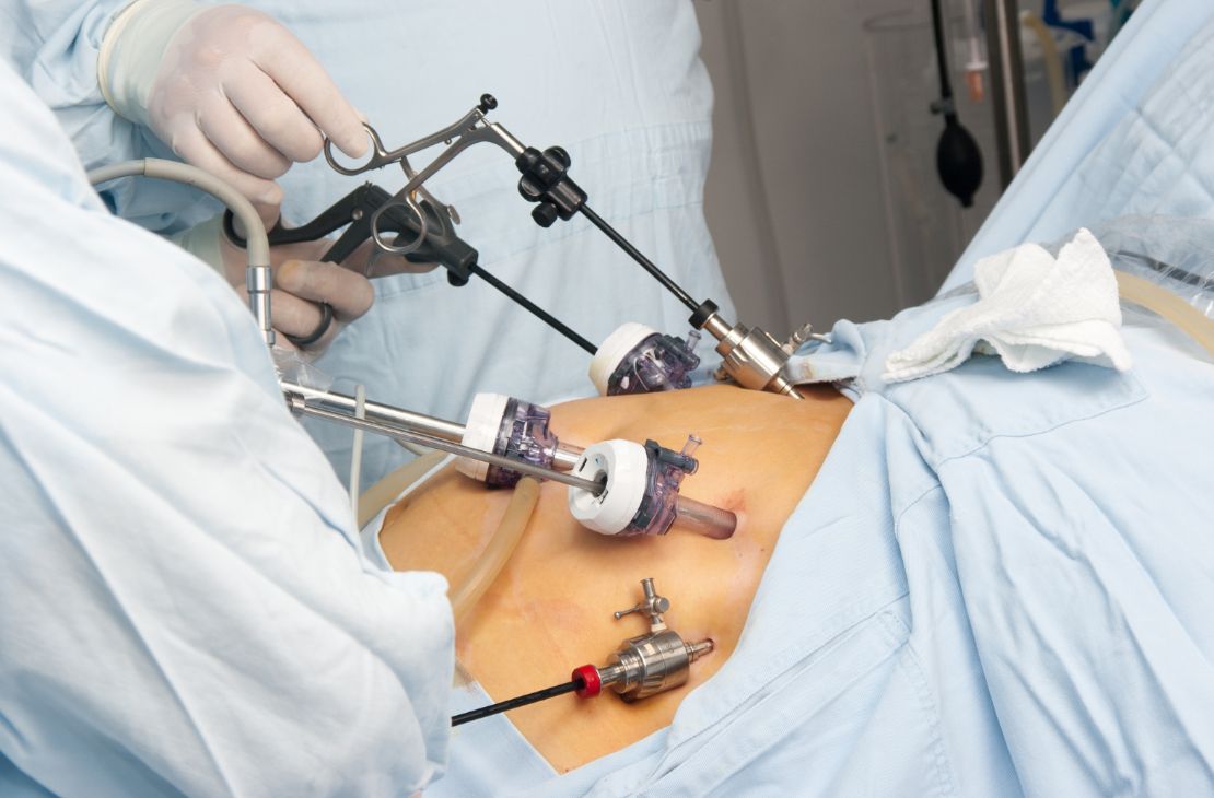 SES amplia acesso à cirurgia bariátrica em MS com triagem criteriosa e novas referências